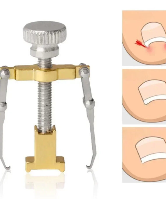 Ingrown toenail corrector (3 pcs)